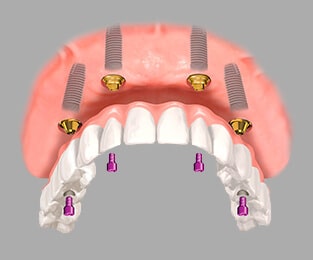 Имплантация зубов «под ключ» Томск Белая